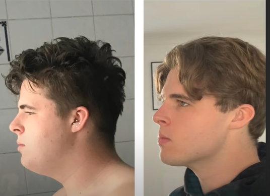 Como Reduzir a Gordura Facial e Melhorar Sua Aparência
